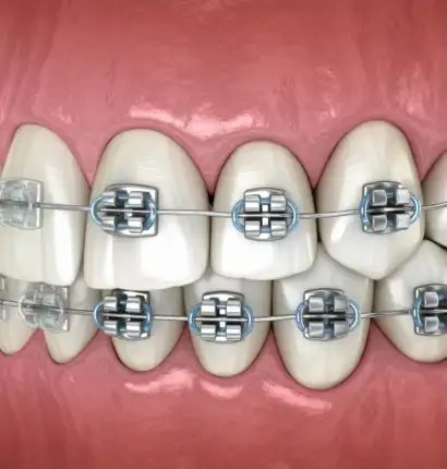 Metal Braces (Traditional Braces)