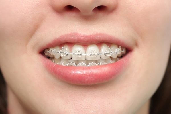 Ceramic Braces