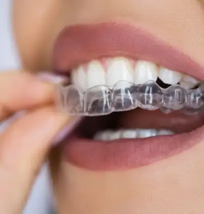 Invisible Aligners